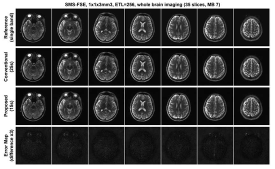 다중슬라이스 multiplexing 설계를 통해 임상적으로 가능한 시간 내에 고속으로 얻은 영상. 기존의 다중 슬라이스 기법에 비해 획기적으로 단축된 시간 안에 참조 영상과 비슷한 성능을 나타냄