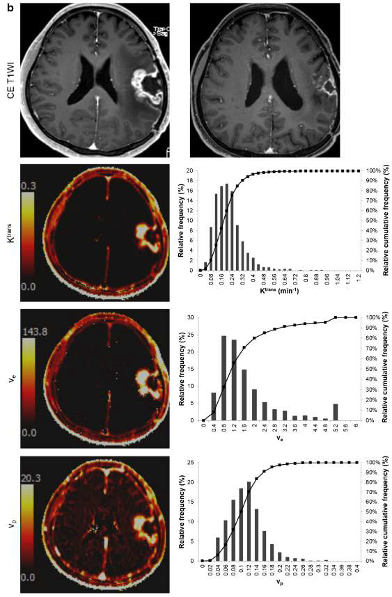 대표적 DCE MRI-derived 약동학적 parameter map, (a) progression (b) non-progression. (a) 는 GBM 이 있는 63세 남자로 Ktrans, Ve, Vp 값이 (b)에 비해서 낮음을 확인하였음