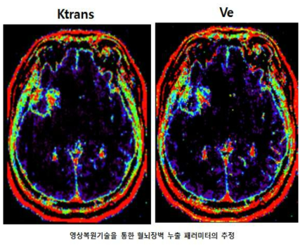 영상복원기술을 통한 BBB 누출 패러미터 (Ktrans)의 추정