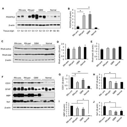 Analysis of cell-specific markers. In the analysis for PDGFR-β, the contrast-enhancing core tissue of radiation necrosis (RN-core) had a significantly decreased level of PDGFR-β expression compared to the contrast non-enhancing peri-lesional tissue of radiation necrosis (RN-peri) or to GBM, as shown by Western blotting (a) and densitometry (b). In analysis of the active form of RhoA, there was no difference among the groups, as shown by Western blotting (c) and densitometry (d). In addition, there was no differences among the groups in the analysis of the total form of RhoA (e). In the measurements of CD31, RN-core tissue had higher levels of CD31 compared to the RN-peri or to normal tissues, as shown by Western blotting (f) and densitometry (g). The expression of GFAP was higher in the RN-core compared to the other groups (f, h). The expression of MBP was higher in the RN-core, RN-peri, and GBM groups compared to the normal tissues. In the analysis of Iba1, RN-core had increased expression of Iba1 compared to the other groups, as shown by Western blotting (f) and densitometry (j). The tissue origin for each blotting band (i.e., the order of gel loading) is noted in (a). C1=Case #1, C2=Case#2, C3=Case#3, B1=brain bank tissue #1, B2=brain bank tissue#2, B3=brain bank tissue#3. *P < 0.05, **P < 0.01. Bars show mean ± s.e.m