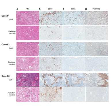 Immunohistochemistry of GBM and radiation necrosis tissues for endothelial and pericyte markers. a H&E staining showed the typical pathological features of GBM and radiation necrosis in each cases. b In anti-CD31 immunohistochemistry, all of the GBM and radiation necrosis tissues had abundant expressions of CD31. c and d However, in the immunohistochemistry of CD34 and PDGFR-β, the radiation necrosis tissues showed a loss of markers, whereas the GBM tissues had abundant expression of the markers, which indicates the loss of pericytes in radiation necrosis