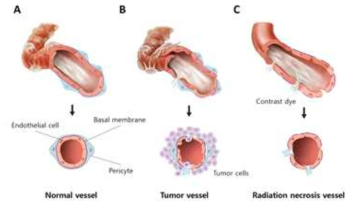 Schematic illustration of vascular structures in normal brain, glioblastoma and radiation necrosis. a Normal vessel with intact endothelial cell, basal lamina, and pericyte. b Tumor vessel in glioblastoma shows disorganized shapes such as abnormal patterns of pericytes, weak association between endothelial cells, and irregular basal membrane. These morphological alterations in tumor vessels are associated with tight junction disruption, which are reasons for the contrast-enhancement in MRI in tumor tissue. c Vessel in radiation necrosis shows loss of pericytes resulting in defects in vessel integrity which can be the cause for leakage of contrast dye