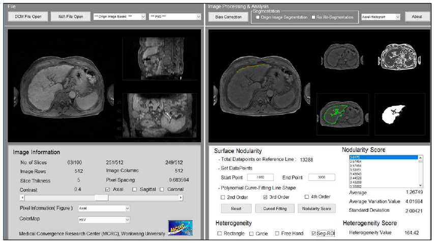 자기공명영상(MRI)을 이용한 간표면 소결절(LSN) 정량화 예시 화면