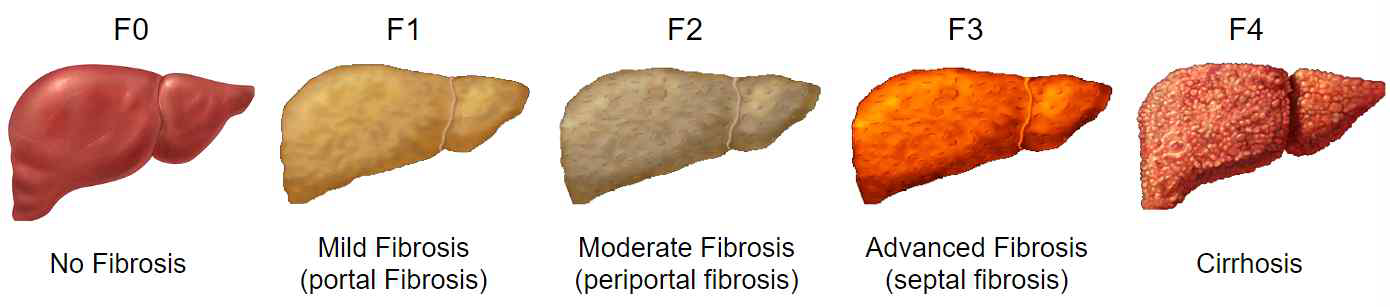 간 섬유화 등급 분류(liver fibrosis grade)