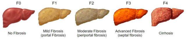 Liver Fibrosis Classification 정의