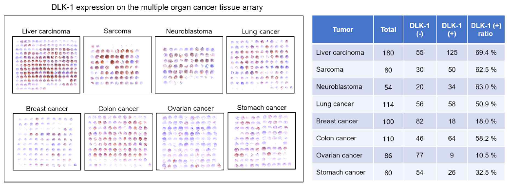IHC 분석을 통한 인간의 다양한 암조직에서 DLK1 발현 확인
