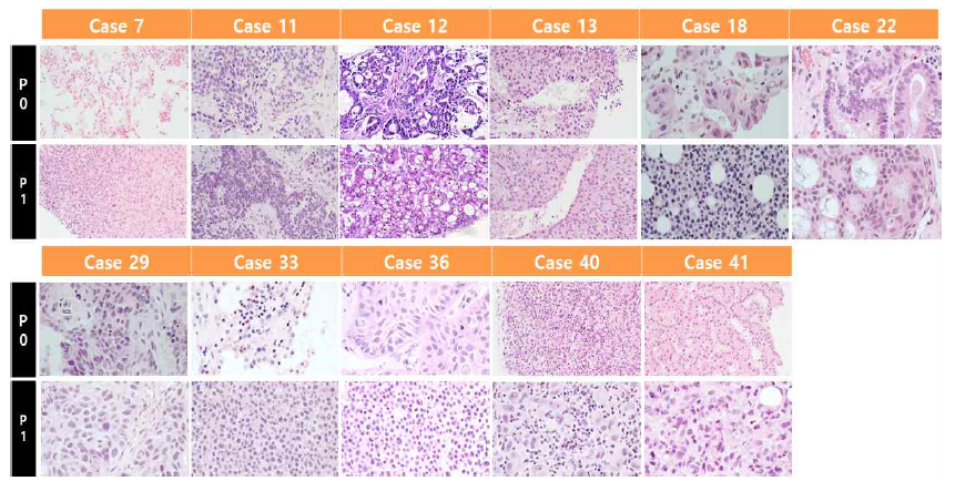 폐암 조직 Histology 비교한 H&E 사진