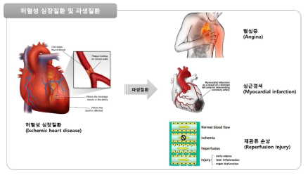 허혈성 심장질환 및 파생질환 종류