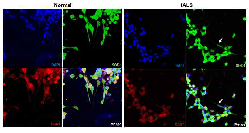 fALS derived motor neuron에서의 SOD1 aggregation