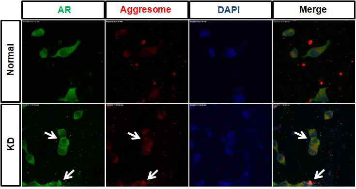 KD derived motor neuron에서의 AD aggregation