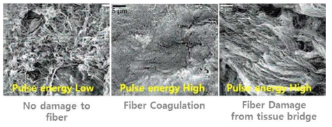레이저 펄스 에너지에 따른 각막 섬유층 열 손상 비교