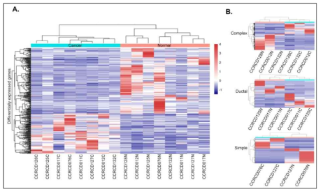 Heatmap clustering. (A) 암과 정상 그룹에서 차이나게 발현되는 유전자 그룹은 heatmap clustering을 통해 암과 정상을 구분지을 수 있음. (B) 각 서브그룹의 유선암들도 전사체 사이로 정상과 암을 구분지을 수 있음