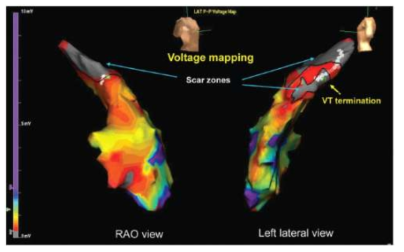 심장의 우심실에 대한 voltage mapping의 예