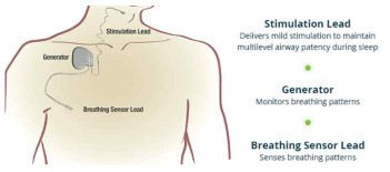 기도 신경 자극 수면 무호흡증 치료 전자약. (Inspire medical systems)