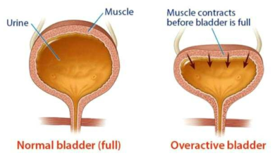 과민성방광(Overactive Bladder, OAB)