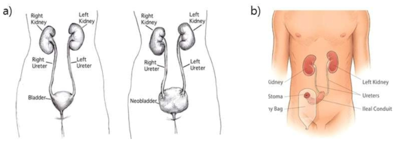 신방광성형술(Neo-bladder)의 사용(좌), 회장도관 요루성형술(우)