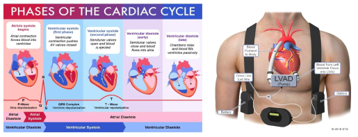 심장박동 동기화 순서(좌), 현재 개발된 LVAD 모식도(우)