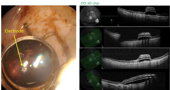 (좌) 돼지 안구 내(sub-retinal approach)에 삽입된 전극의 모습과 (우) 삽입된 전극의 OCT 단층 촬영 사진