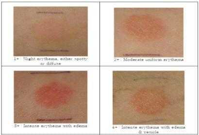 Clinical standard photographs of visual assessment for human patch test