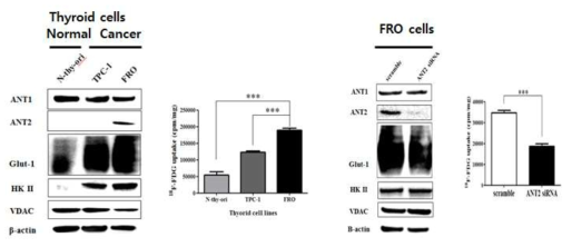 갑상선 종양 세포에서의 ANT2 발현 및 18F-FDG 섭취 비교