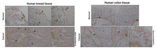 인체 유방과 대장 정상조직과 암조직에서 alpha-SMA 분석