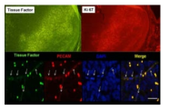 염증성 반응의 주요 매개체인 tissue factor에 의한 망막모세포종 종양혈관 발현