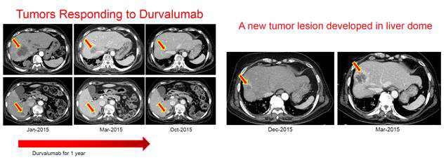 Durvalimab 사용 폐암 환자에서 항암면역치료제에 대한 내성 발생 예