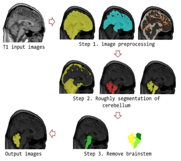 자동 소뇌 영역 추출 기술의 전체 과정