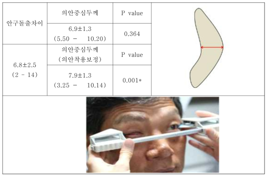 무안구 환자 안구돌출 차이와 의안 두께 (mm) 의 상관성