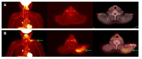 79세 남자 환자. 좌측 침샘암으로 침샘 절제술 및 경부 림프절 절제술을 시행받음. 수술 전 FDG PET/CT 상에서 관찰되지 않던 좌측 승모근 의 FDG uptake 증가가 수술 후 9개월째 시행한 FDG PET/CT에서 확연히 관찰됨. A)수술 전, B)수술 후
