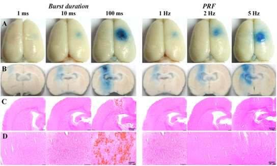 burst duration과 PRF 증가에 따른 뇌혈관장벽 개방 및 손상 비교