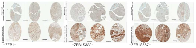 인간의 pancreatic cancer tissue array 슬라이드에서 ZEB1 발현 확인
