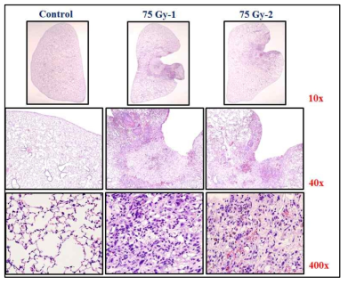 H&E 염색을 통한 폐렴, 폐섬유화 손상평가 시스템 구축. 75Gy 6주 마우스 모델에서 폐를 적출한 후 10% formaldehyde를 이용하여 고정시킴. 조직을 탈수과정을 통하여 paraffin block을 만듬. paraffin block으로 만든 조직을 microtome을 이용하여 4㎛ 로 자름. slide glass 위에 조직을 올려, paraffin을 제거하고 Hematoxylin & Eosin (H&E) 염색을 시행