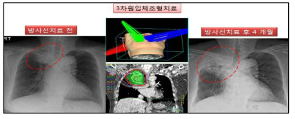 실제 임상 예) 60세 환자, 방사선치료를 3차원입체조형치료법으로 66 Gy 까지 시행하여, 우측폐 상엽에 있던 종괴는 사라졌으나, 연이어 종양이 있던 부위 및 주변 정상조직에 심각한 기침 및 호흡곤란 증상을 동반한 방사선폐렴 발생을 상기 그림에서 보여주고 있음. 좌측 그림 - 치료 전, 가운데 그림 - 방사선치료 계획, 우측 그림 - 방사선조사 부위 발생한 폐렴