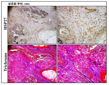 폐암환자 폐조직 섬유화 진행 부위에서 HSP27 발현정도
