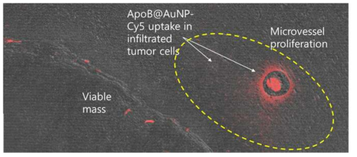 MVP종양침윤 조직의 혈관을 따라 증식하는 종양세포에 uptake된 apoB@AuNP-Cy5의 형광영상. MVP주변에 침윤세포에 uptake됨을 보여주며, 혈관 내부의 형광은 혈류에 남아 순환하는 apoB@AuNP-Cy5를 보여줌