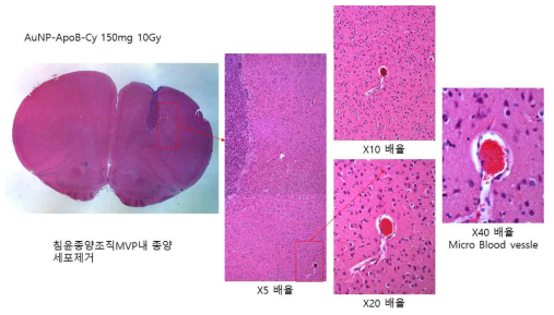 TPBP-10Gy-150 mg-apoB@AuNP처리군에서 치료후 주종괴가 완치되어가는 모습과 MVP 주변 침윤종양세포가 사라진 모습