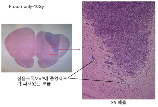 양성자 단일 처리 대조군에서 Microvessel Proliferation종양침윤조직을 따라 종양세포가 퍼져 있는 모습 (치료되지 않은 상태)