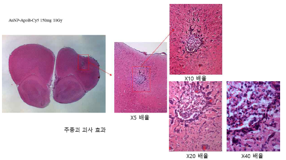 치료효과가 잘된 경우, 주종괴의 괴사도 complete response에 이르는 과정으로 거의 치료가 되어가는 case