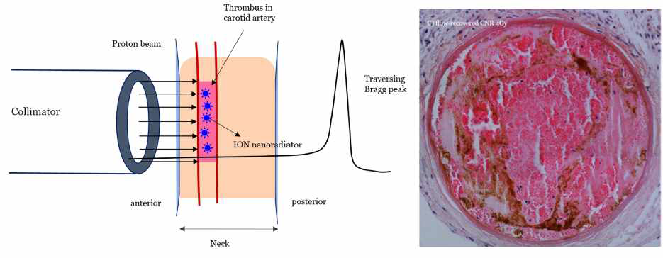 100 MeV 투과성 양성자를 마우스 경동맥 혈전 모델에 투과 시켜 쿨롱 나노라디에타 혈전용해 시험도 (왼쪽)와 혈전이 용해되어 혈류가 개존되고, 손상없는 혈관조직과 내부 모습(오른쪽 그림)