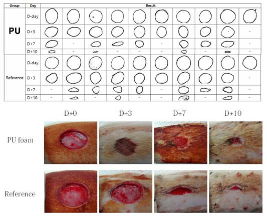 Visual observation of wounds treated with PU foam