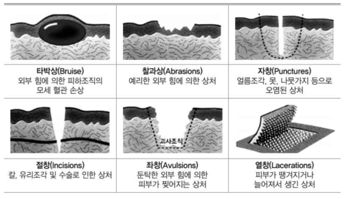 Classified according to the cause of the wound