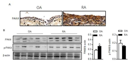 퇴행성관절염과 류마티스관절염에서 PAK4의 발현 양상