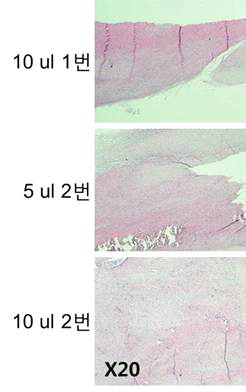 collagenase vol및 주사법에 따른 차이(62.5 UI/10ul)