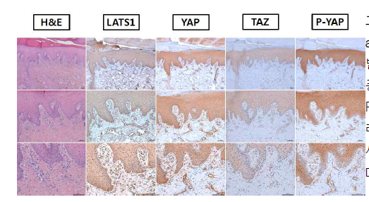 The expression of LATs1, YAP, TAZ, and p-YAP on melanoma tissue (sole). 발바닥에 발생한 악성흑색종 환자에서 악성흑색종 세포에서 YAP, TAZ의 발현이 증가하였으며 P-YAP의 발현은 감소하였음. 피부암 환자들의 레지스트리를 구축하였으며 악성흑색종 환자에서의 조기 진단 가능성을 타진하였음( Br J Dermatol 2018)