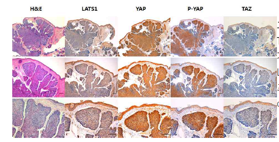 The expression of LATs1, YAP, TAZ, and p-YAP on basal cell carcinoma. 기저세포암(basal cell carcinoma) 환자에서 LATs1발현에 비해 YAP, P-YAP의 발현이 세포질과 핵에 증가하였음. P-YAP의 경우 center에서의 발현이 증가하는 양상임