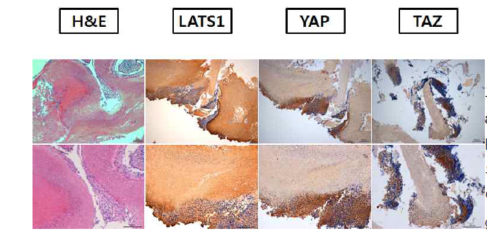 The expression of LATs1, YAP, and TAZ on pilomatricoma. Pilomatricoma 환자에서 LATs1, YAP, TAZ의 발현이 증가하였음. YAP, TAZ의 발현은 이행세포의 세포질에서 증가하여 있으마 ghost 세포에서는 발현 양상이 감소함. 피부 모낭의 matrix cell에도 Hippo 신호전달 경로 물질이 발현되며, matrix cell에서 기원한 양성 종양인 pilomatricoma에서도 발현 양상의 변화가 있음을 확인하였음. Pilomatricoma등 양성 종양에서의 hippo 신호전달 경로의 관련성을 탐색하였음