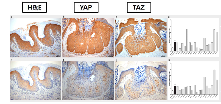 The expression of YAP and TAZ on molluscum contagiosum. 정상 피부병변에 비해 mollusucm contagiosum 환자의 조직에서 YAP, TAZ의 발현이 molluscum inclusion body 주위에 뚜렷이 증가되어 나타나며, 정량적 RT-PCR에서도 대조군에 비하여 molluscum 조직에서 YAP, TAZ의 발현이 유의하게 증가함을 관찰하였음 (Br J Dermatol 2018). 바이러스 감염된 세포 및 주위에서 Hippo 신호전달 경로 관련 물질의 증가를 확인하였으며 피부 표피의 증식에 관여함을 규명하였음