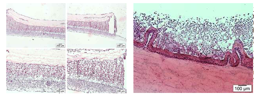 3D model of melanoma Collagen base 위로 keratinocyte, melanoma cell을 seeding 하여 악성흑색종 3D모델을 구축하였으며 해당 모델을 이용하여 Hippo 신호전달경로의 발현 정도와 치료제에 따른 변화 양상을 연구하고 있음