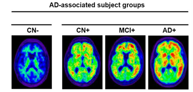 PIB-PET영상에 따른 알츠하이머성 치매 환자의 분류